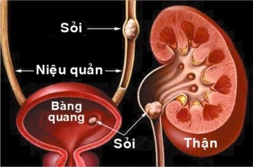 hình ảnh sỏi bàng quang