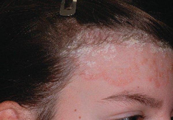 Nấm da đầu là bệnh gì