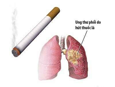 dau-hieu-ung-thu-phoi