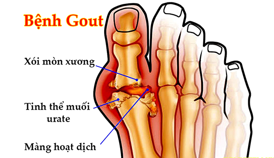 dau-hieu-benh-gout