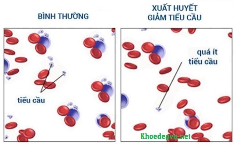 benh-giam-tieu-cau