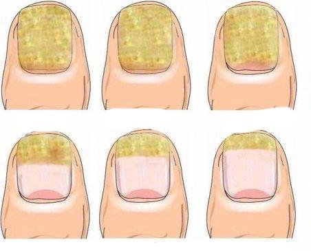 các dạng nấm móng thường gặp