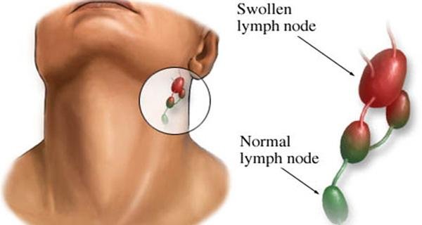 nhiễm hpv ở phụ nữ