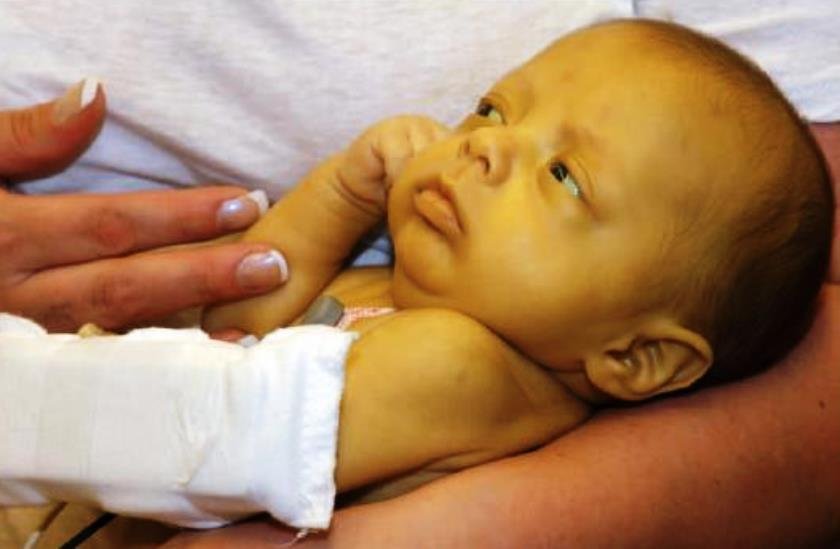 Trẻ sơ sinh bị vàng da có nguy hiểm không, phải làm sao?