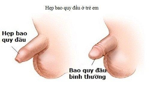 dau-hieu-tre-bi-hep-bao-quy-dau